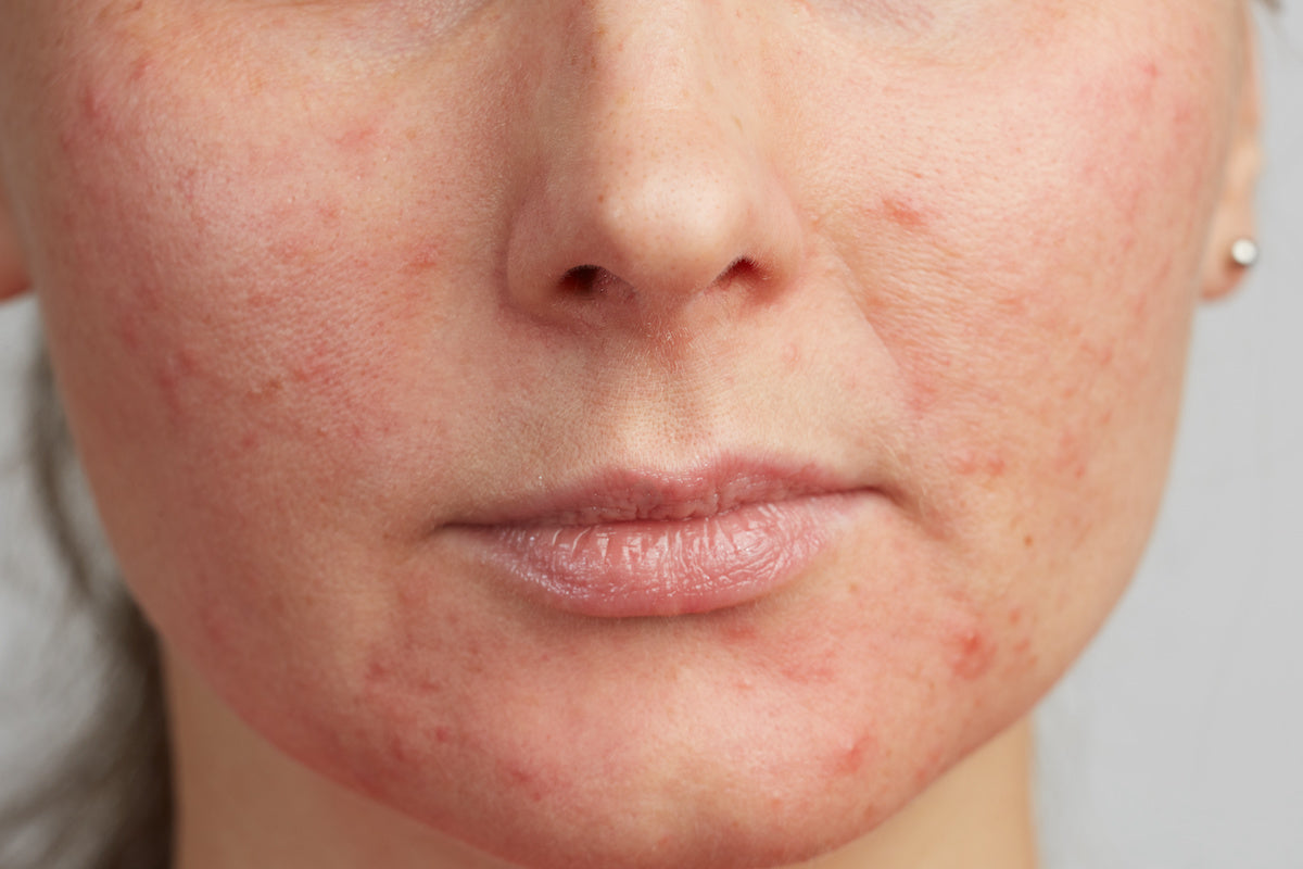 How to control Hormonal Acne