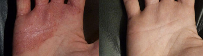 Eczema · Hands · 1 Week · Tina F.